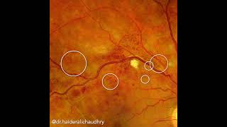 Branch Retinal Vein Occlusion eyedisease ophthalmology retina [upl. by Atiral]