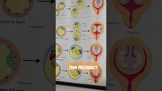 dizygotic and monozygotic definition for TWINS Pregnancy 😳😍 [upl. by Arber378]