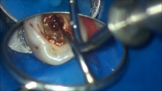 furcation perforation closure  закрытие фуркационной перфорации [upl. by Romo]