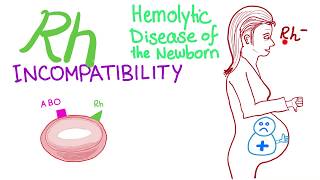 Rh incompatibility and Hemolytic disease of the newborn HDN [upl. by Edith]