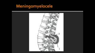 Spina Bifida Occulata Meningocele amp Meningomyelocele [upl. by Secilu]