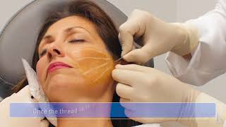 NovaThread  NonSurgical Face lift at the biostation with Dr Gallo [upl. by Vasili]