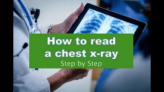 02 Chest xray cases CT scan and MRI [upl. by Frayne]