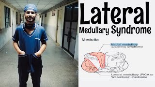 Lateral Medullary Syndrome Neuro medicine viva [upl. by Ynaoj]