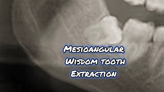 Mesioangular Wisdom Tooth Extraction Video with Oral Surgery Tipe [upl. by Jara]