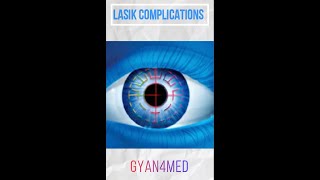 Risks of LASIK Surgery  Laser eye surgery complications [upl. by Berkman]