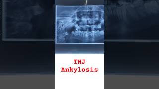 Temporomandibular joint TMJ ankylosisLocked jawdentaltreatmenttrismusreducedmouthopening [upl. by Mccully241]