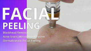 Blackhead Removal  Acne Scars  Microdermabrasion Dermabrasion Facial Peeling [upl. by Brackett908]