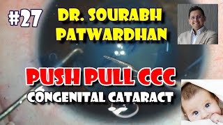 Commented 27 Push Pull technique Capsulorhexis TIPP in congenital cataract Dr Sourabh Patwardhan [upl. by Reuben]