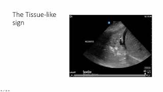 Lung Ultrasound Alveolar Consolidation  Shred Sign [upl. by Lauer468]