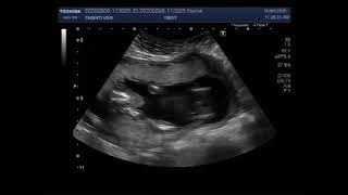 Ultrasound Video showing Pregnancy of about 18 weeks with Anencephaly [upl. by Norret]