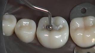 Class I Amalgam Preparation amp Restoration  Operative Dentistry [upl. by Rennold]