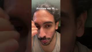 Accutane day 36 acne accutane acnetreatment [upl. by Phare391]