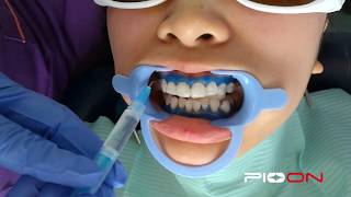 Teeth Whitening Bleaching [upl. by Purcell]