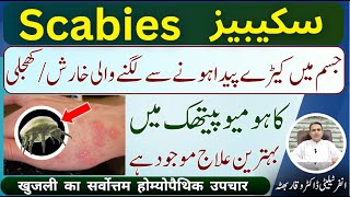 Scabies شدید خارش اور کھجلی शरीर में कीड़ों से खुजली होना Homeopathic Treatment In Urdu  Hindi [upl. by Aubigny]