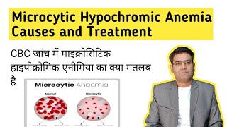 What is Microcytic Hypochromic Anemia its Causes and Treatment in Hindi Iron Deficiency [upl. by Ardnued]