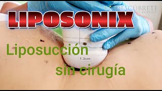 ¡Transforma tu Figura sin Cirugía Conoce El Liposonix [upl. by Ellenrahc]