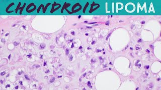 Chondroid lipoma has lipoblasts but not liposarcoma Basic soft tissue pathology [upl. by Seravaj]