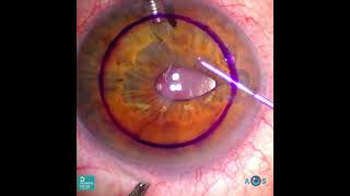 The smooth Descemet peel in a DSEK corneal transplant ophthalmology [upl. by Funk]