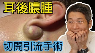 耳後膿腫  發炎粉瘤  膿瘡  皮膚專科  皮膚手術  切開引流術  Epidermoid Cyst  Sebaceous Cyst  Ear Abscess [upl. by Trisa]