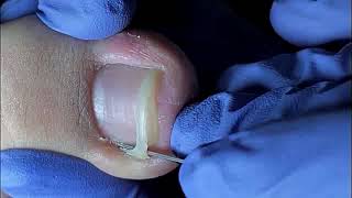 DIY Ingrown Toenail Removal  How to Safely Cut Ingrown Toenails at Home [upl. by Lasonde]