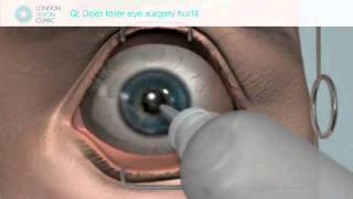 Does laser eye surgery hurt [upl. by Calondra]