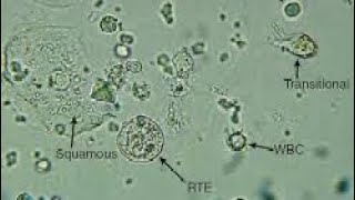 Urine Sediment Epithelial Cells [upl. by Aranat830]