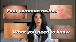 Four common rashes and everything you need to know about them [upl. by Pacian228]