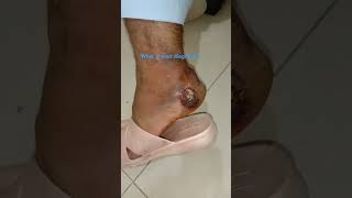 Lateral side of ankle fungal infection [upl. by Kaile]