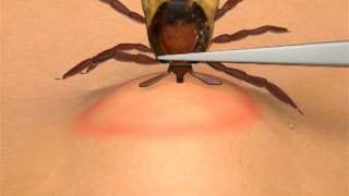 How To Remove A Tick [upl. by Cornela229]