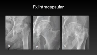 Fracturas de miembro inferior [upl. by Rokach]