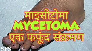 Mycetoma in hindi [upl. by Park868]