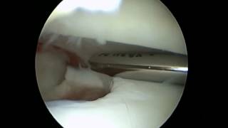 ASK OSG mit osteochondralem Flake [upl. by Assil]