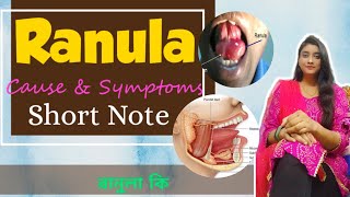 Ranula কী  plunging ranula  mucocele  treatment of RANULA  Etiology Clinical Features [upl. by Durnan750]