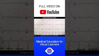 Left Bundle Branch Block LBBB ECG shorts [upl. by Rehsu]