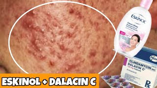 Cheap Acne Solution Eskinol and Dalacin C  WOW EFFECTIVE [upl. by Arahset396]