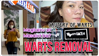 WARTS REMOVAL sa Let’s Face It  Magkano Masakit ba  Irene Nicer [upl. by Leahcam]