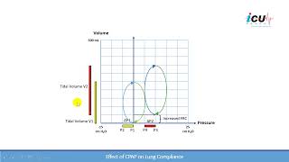 The Effects of CPAP on Lung Compliance [upl. by Melicent494]