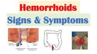 Hemorrhoids Signs amp Symptoms  Internal vs External Hemorrhoid Symptoms  Hemorrhoidal Disease [upl. by Llerref]