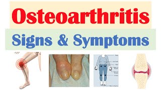 Osteoarthritis Signs amp Symptoms amp Why They Occur [upl. by Aveline]