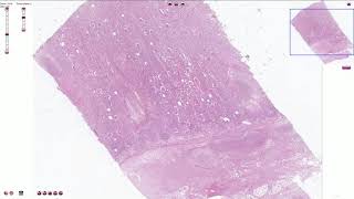 Acute Pyelonephritis  Histopathology [upl. by Anhavas479]