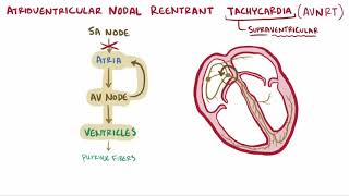 Atrioventricular reentrant tachycardia AVRT amp nodal reentrant tachycardia AVNRT [upl. by Kassab]