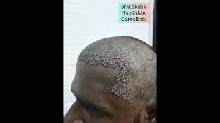 Hair transplantationShubiksha hairampskin care clinictrendingbalaji Nagarkatturtrichy9150923153 [upl. by Cybil230]