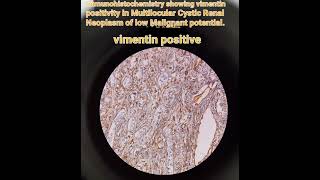 Histopathology IHCRenal neoplasm pathologymedicalvimentinrare case [upl. by Dominica412]