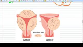 Adenomyosis  Concept  Diagnosis Management [upl. by Tuorah]