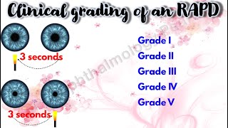 Pupil 4  Clinical grading of an RAPD  Marcus Gunn Pupil [upl. by Vey]