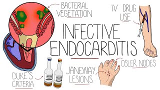 Infective Endocarditis With Duke Criteria amp Pathophysiology [upl. by Caundra]