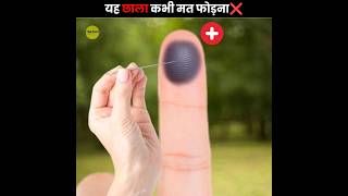 खून🩸 का छाला कभी मत फोड़ना ❌  Dont Pop Blood Blisters  The Fact  shorts ytshorts [upl. by Ardath]