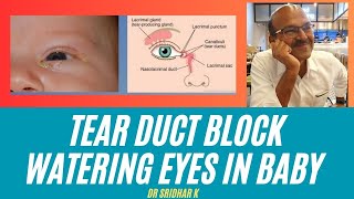 Tear duct block in babies l Nasolacrimal duct obstruction and watering eyes [upl. by Shamus]