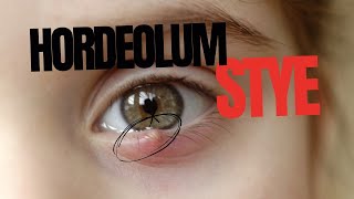 Stye Hordeolum [upl. by Servetnick]